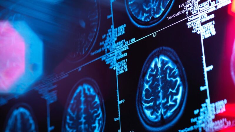 Descubren lo que causa la rápida muerte de células cerebrales y la demencia en la enfermedad de Alzheimer ?