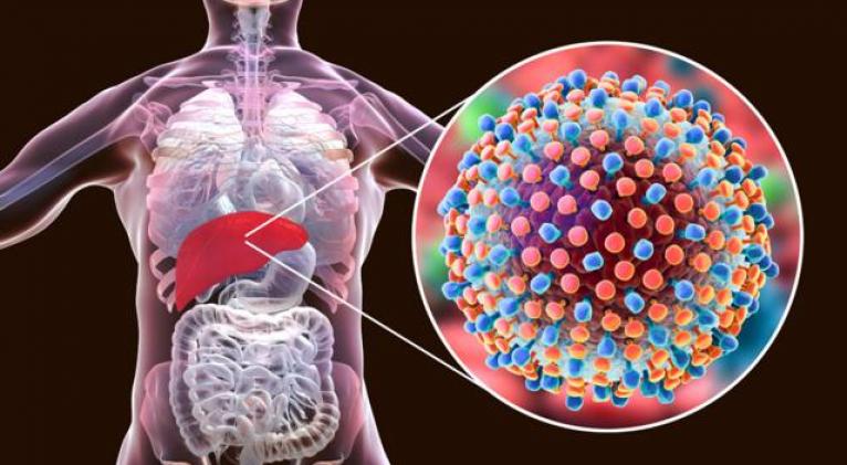 Reconocen a la hepatitis como la segunda causa infecciosa de muerte