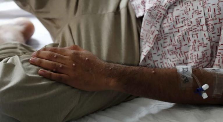 OMS transmite tranquilidad ante brote de mpox en Africa y un único caso en Europa