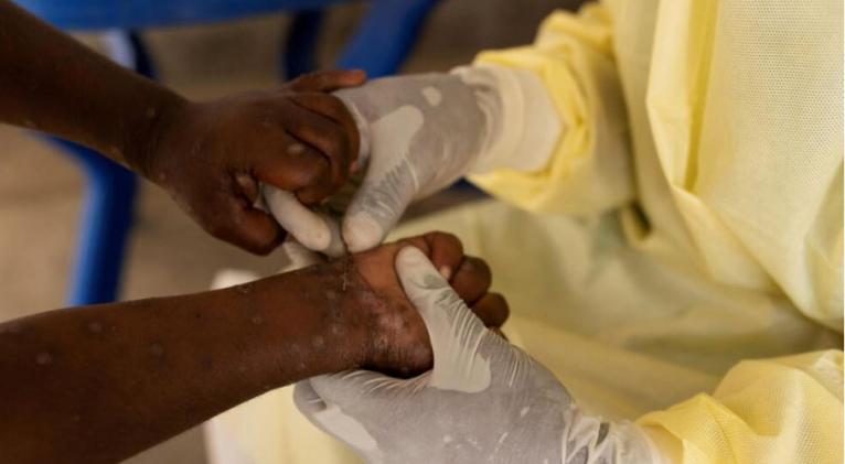 OMS declara brote de viruela símica como emergencia de salud global