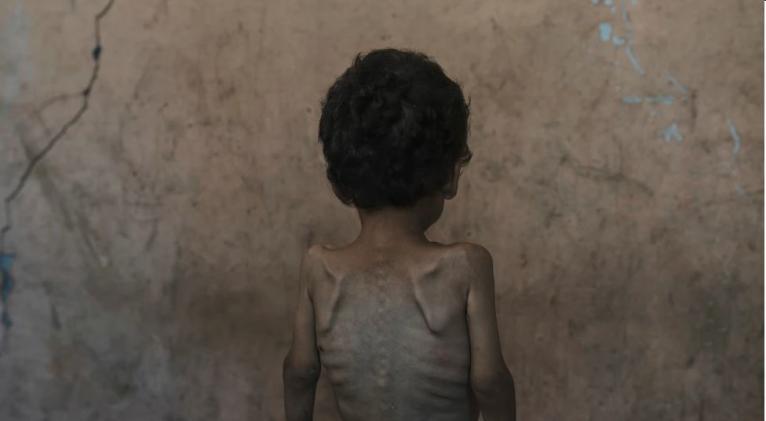 ONU: Casi 55.000 niños en Gaza menores de 5 años podrían estar agudamente desnutridos