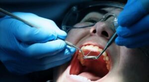 Un gel bio-inspirado regenera el esmalte dental